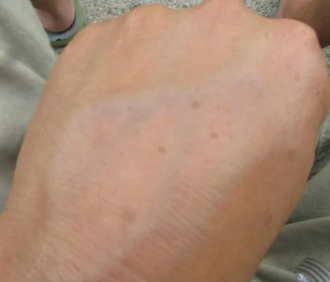 liver-spots-before-liver-cleanse Liver spots before liver cleanse