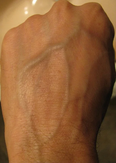 liver-spots-after-liver-cleanse Liver spots after liver cleanse
